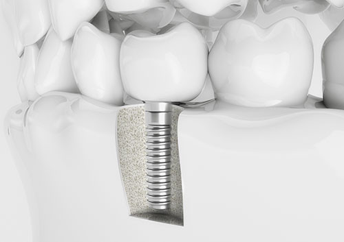 Single Dental Implant